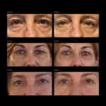 Over Size Eye & Cheek Patches | Trattamento Intensivo Anti-Età